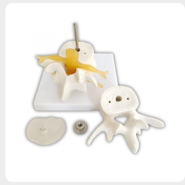 Detachable Lumbar Spine Model Detail View Detachable lumbar spine model showing disc and nerve root details
