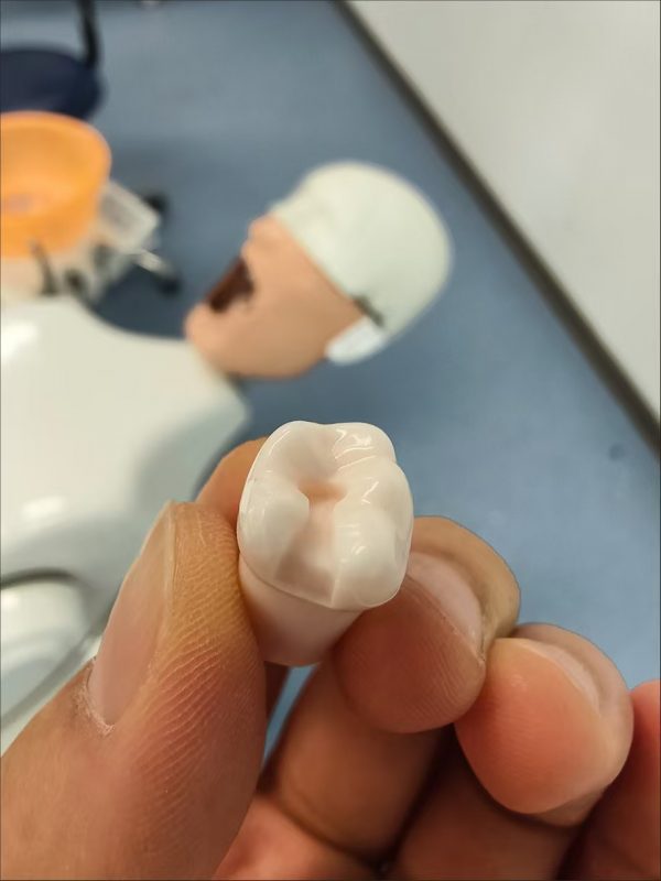 Class Two Cavity Preparation Replacement Tooth A removable resin training tooth positioned with a rubber dam clamp to demonstrate isolation techniques used in operative and restorative dentistry courses.