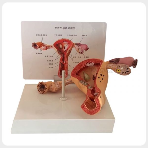 Female Reproductive Pathology Model Cutaway Side View Cutaway female reproductive pathology model with uterus and ovary lesions