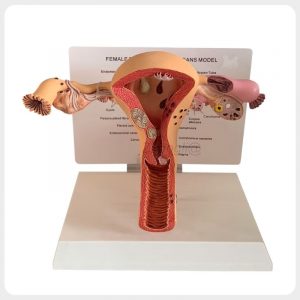 Female Reproductive Pathology Model Front View Female reproductive pathology model showing uterus ovaries and fallopian tubes