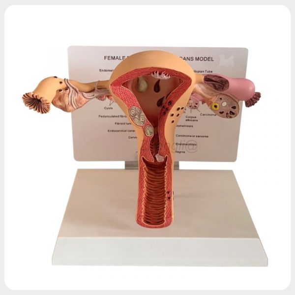 Female Reproductive Pathology Model Front View Female reproductive pathology model showing uterus ovaries and fallopian tubes
