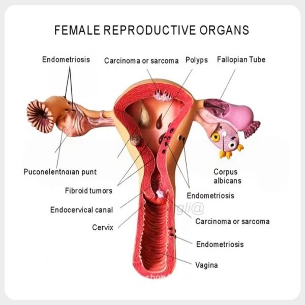 Female Reproductive Pathology Model Labeled Diagram Labeled female reproductive pathology diagram with uterus and ovary lesions