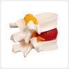 intervertebral-disc-anatomy-model White lumbar disc herniation anatomy model with color coded disc and nerves