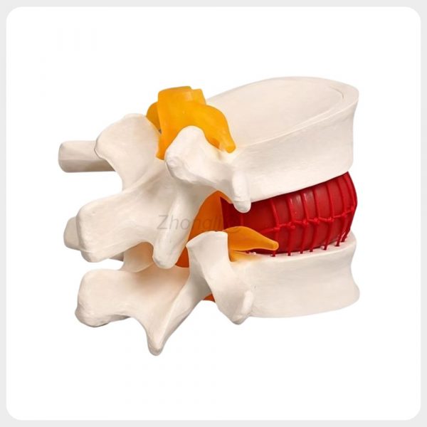 intervertebral-disc-anatomy-model White lumbar disc herniation anatomy model with color coded disc and nerves
