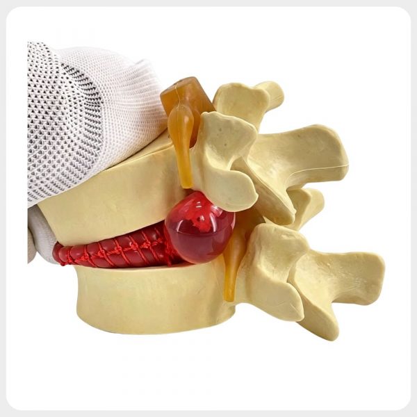 lumbar-disc-herniation-pathology-display Natural bone color lumbar disc model demonstrating herniation and nerve compression