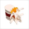 lumbar-spine-disc-model-side-view Lumbar spine disc herniation model posterior side view with nerves