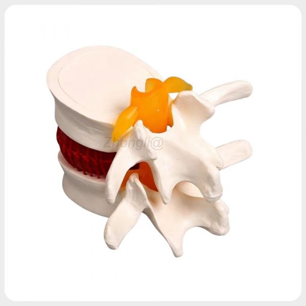 lumbar-spine-disc-model-side-view Lumbar spine disc herniation model posterior side view with nerves
