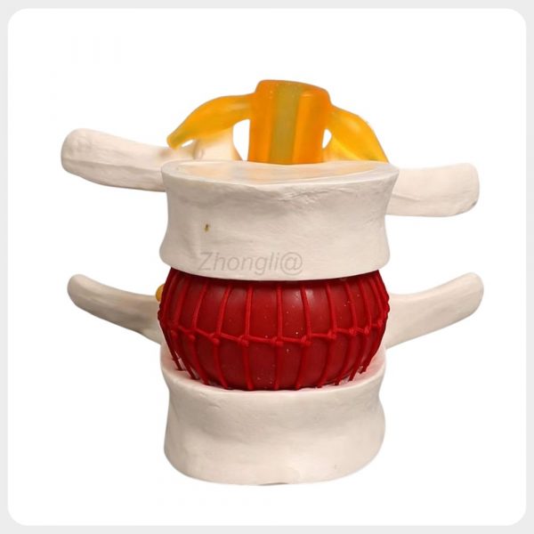 spine-disc-herniation-training-model Lumbar disc herniation training model showing simulated annulus structure