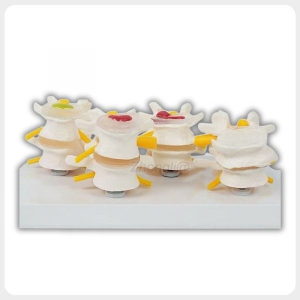 Lumbar Vertebrae Degeneration Comparison Model Front View Four condition pathological lumbar spine model front view