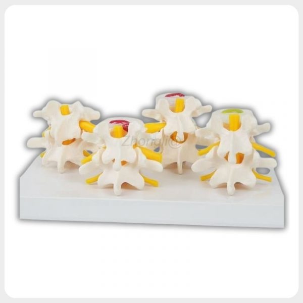 Lumbar Vertebrae Degeneration Comparison Model Posterior View Lumbar spine degeneration comparison model posterior view