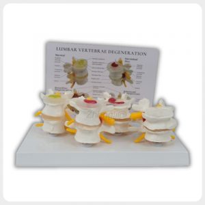 Lumbar Vertebrae Degeneration Teaching Model with Chart Pathological lumbar spine teaching model with English chart